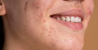 Melasma y paño solar